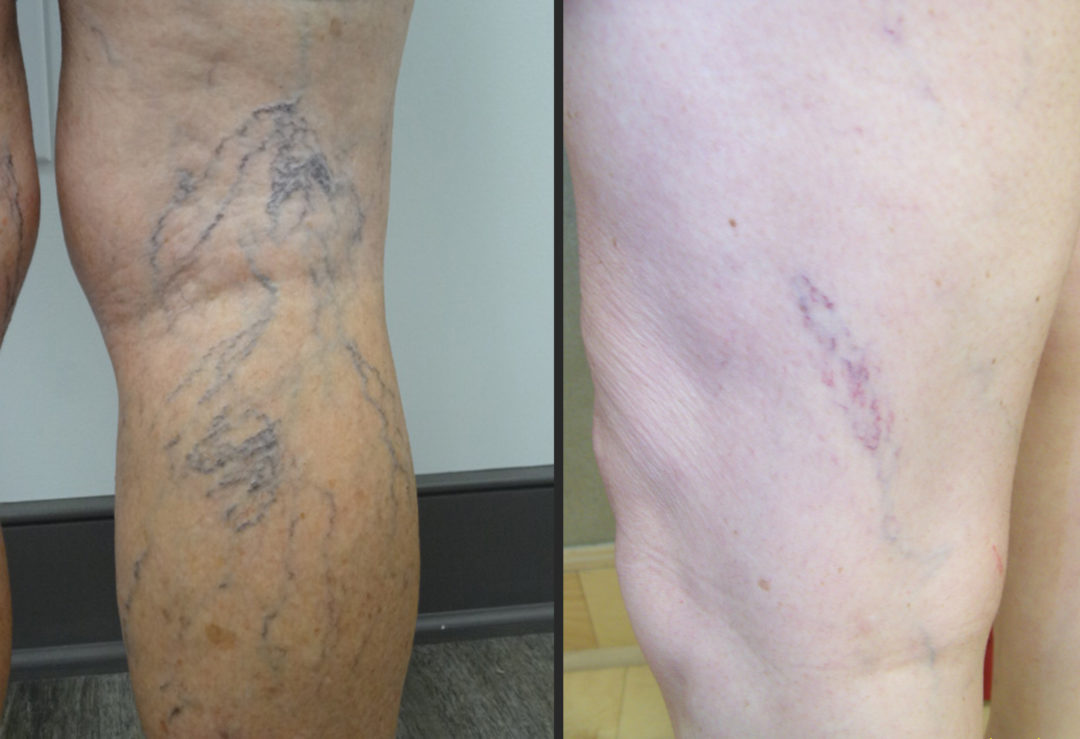 BEFORE & AFTER - Lexington Vein Institute