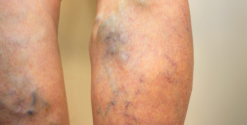 What Causes Varicose Veins? | Lexington Vein Institute