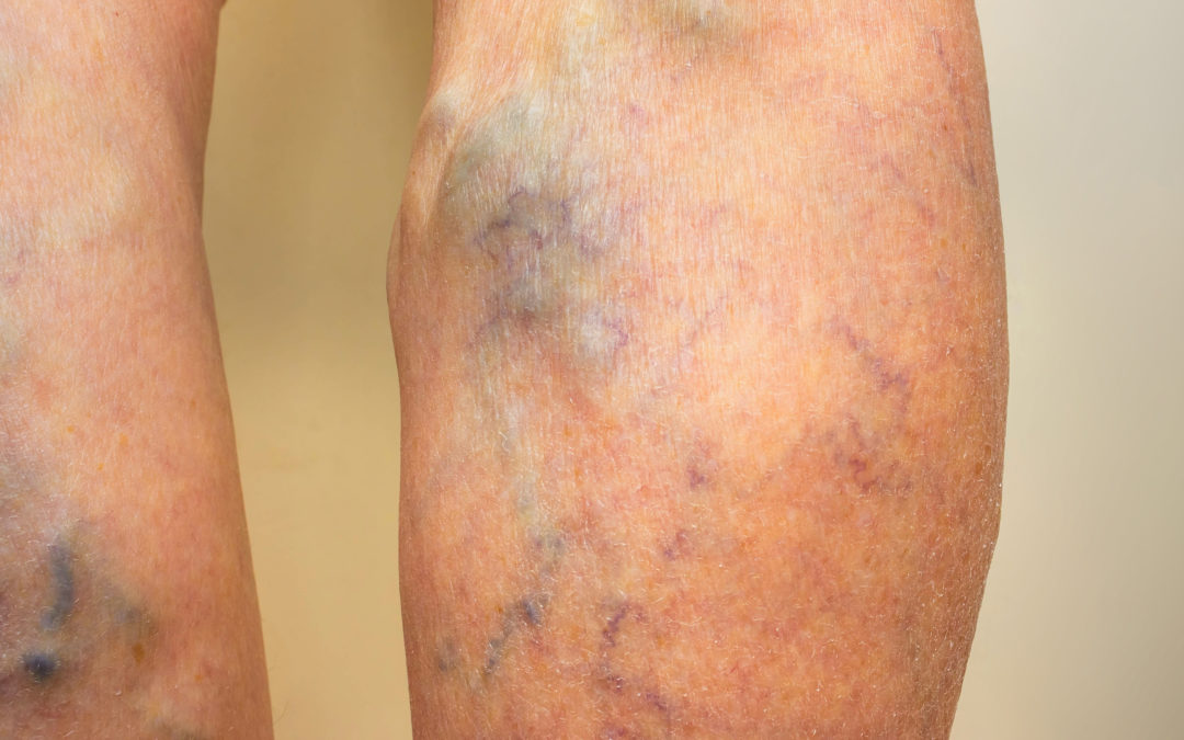 WHAT CAUSES VARICOSE VEINS?
