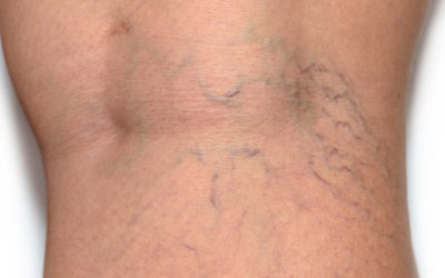 WHAT CAUSES SPIDER VEINS?