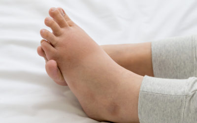 WHAT CAUSES EDEMA?
