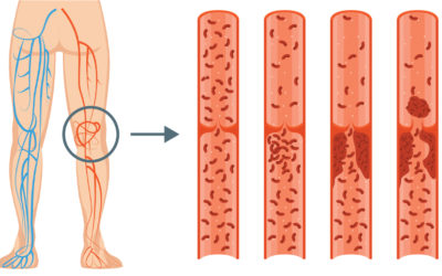 WHAT ARE THE WARNING SIGNS OF DEEP VEIN THROMBOSIS?