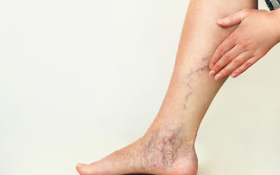 AM I A GOOD CANDIDATE FOR SCLEROTHERAPY?