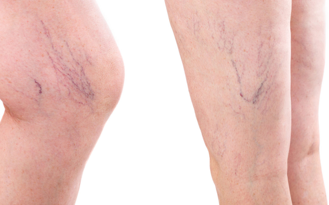HOW TO CARE FOR VARICOSE VEINS IN THE WINTER