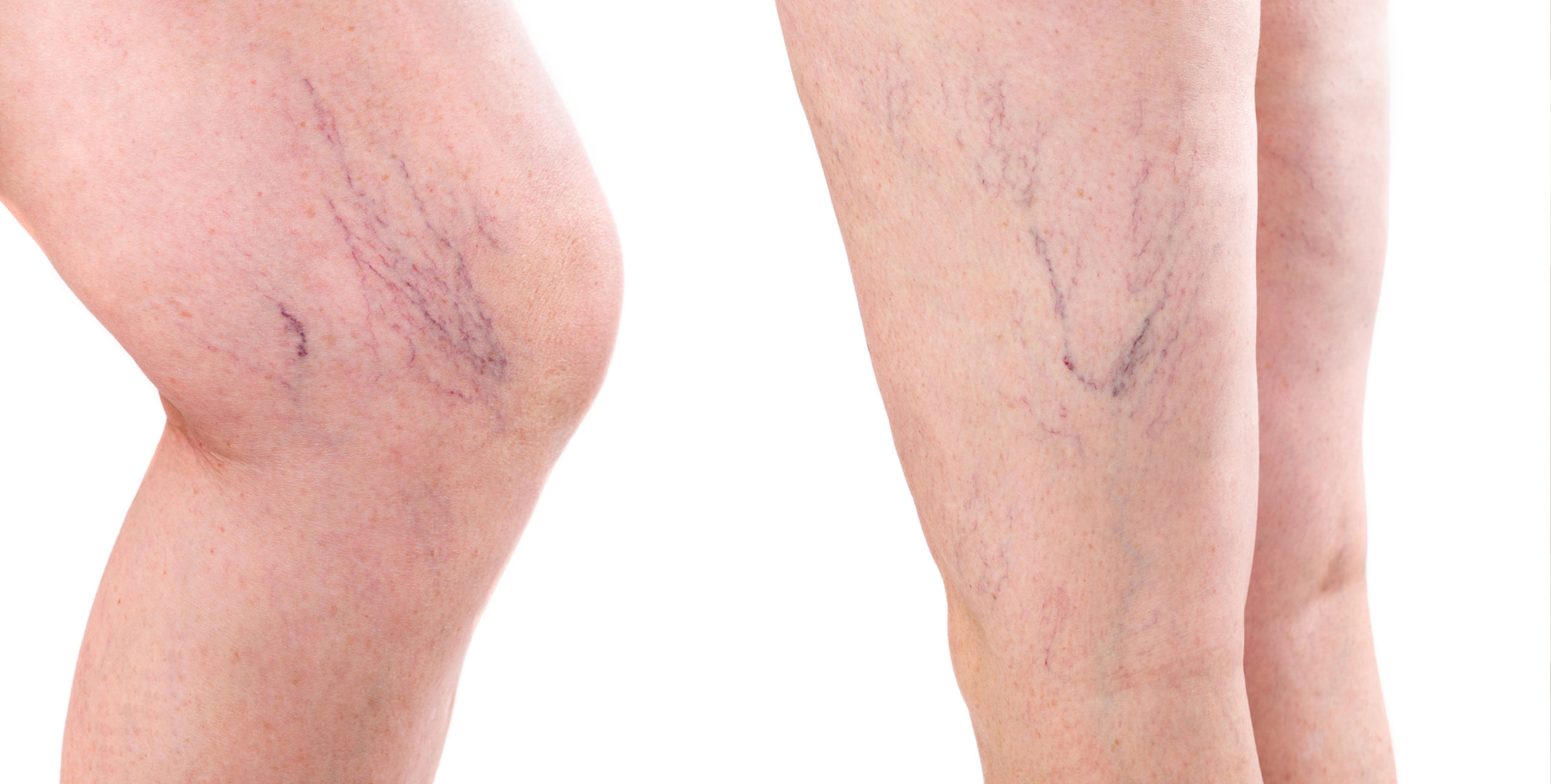 Love Your Legs: Tips for Varicose Vein Prevention